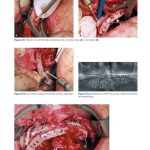 Manejo de Obstáculos Anatómicos en Cirugía Implantar / Marco Rinaldi - Angelo Mottola / AMOLCA