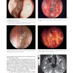 Cirugía Endoscópica de los Senos Paranasales y la Base Craneal Anterior / Malte Erik Wigand / AMOLCA