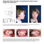 Ortodoncia con el Sistema Tip-Edge y Bracket Plus / Richard Parkhouse / AMOLCA